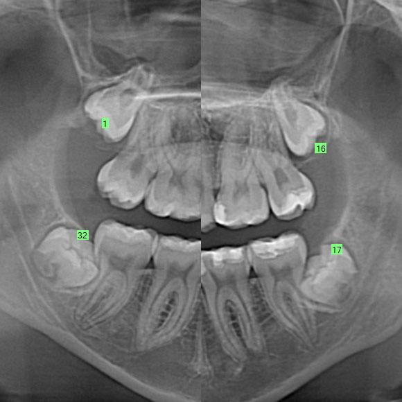 Wisdom Tooth Consult – Teenager with Early Root Formation